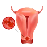 Uterine Body Ayurvedic Treatment