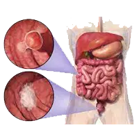 Rectum Cancer Ayurvedic Treatment
