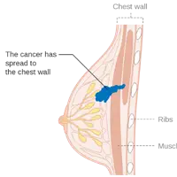 Breast Cancer Ayurvedic Treatment