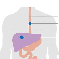 Esophagus Cancer Ayurvedic Treatment