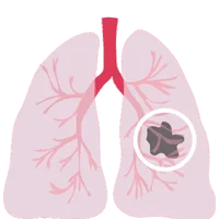 Lung Cancer Ayurvedic Treatment