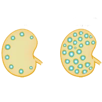 Lymphomas Ayurvedic Treatment