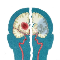 Neurological Tumors Ayurvedic Treatment