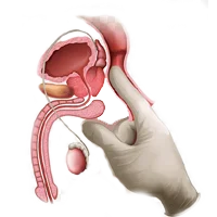 Testicular Cancer Ayurvedic Treatment