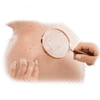 Skin Cancer Ayurvedic Treatment
